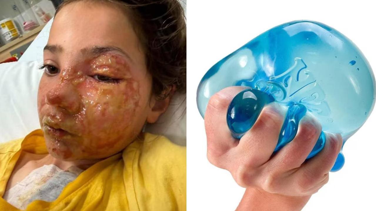 NeeDoh fidget toy explosion leaves girl burned, dad trolled online