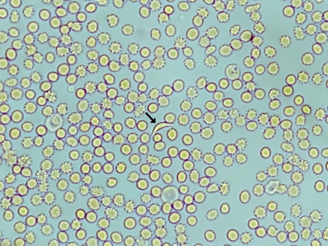 Louisiana Notches a Sickle Cell First