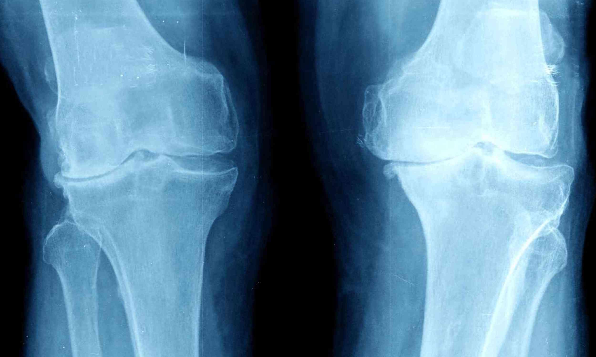 Scientists searched arthritic knees for different diseases and found something unexpected